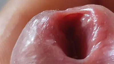 Opening the Scar of the Rough Frenulum!
